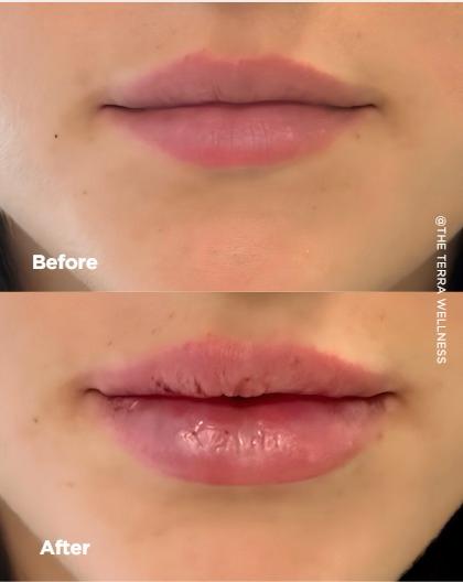 Botox Treatment in Tampa FL